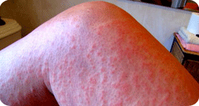 latex allergy, dadode, pitti, blood allergy test, skin allergy test
