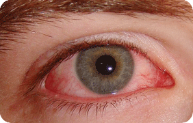 Allergic conjunctivitis, allergy from eyes, eyes allergy, red eyes, itching eyes, water eyes