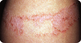 mold allergy test, fungle test, skin problem, skin itching, blood skin test