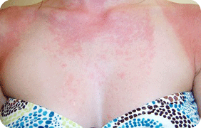 skin allergy, skin allergy test, allergy test, blood allergy , blood test