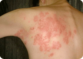 Purities, Itch on Skin, allergy , asthma, allergy test, asthma test in indore, Allergy Test
Blood Allergy Test
Chest Specialist
Allergy Specialist
TB Specialist
Sleep Apnea
Bronchoscopy
Asthma 
Bronchial Asthma
Asthma Specialist 