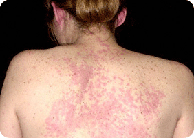 hives, Chest Specialist in Indore, India
Allergy Asthma Specialist in Indore
Best Asthma Allergy doctor 
Best Chest Specialist 
Allergy Vaccines
Pleural Effusion
Cough
Allergic Rhinitis
Atopic Dermatitis
Urticaria